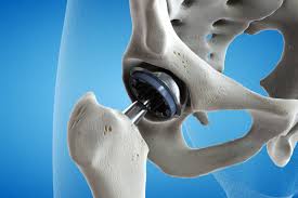Bone Replacements Devices