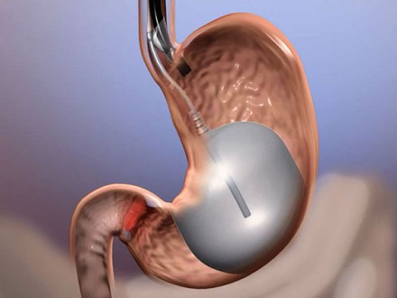 gastric balloon
