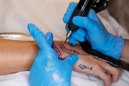 Tattoo Removal Market
